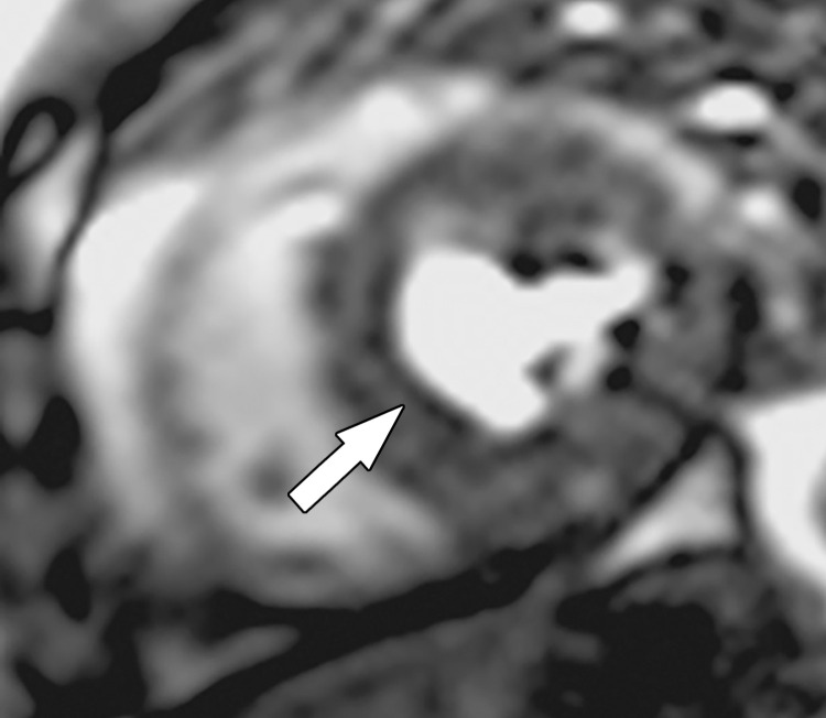 Dark rim artifact at stress perfusion imaging in a 48-year-old woman with a history of Poland syndrome and atypical chest pain. Mid left ventricular short-axis stress perfusion image shows a thin subendocardial area of low signal intensity (arrow) in this patient with normal coronary arteries, consistent with a dark rim artifact.