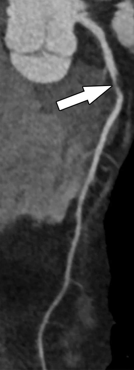 Abnormal exercise stress ECG result in a 52-year-old woman with type II diabetes mellitus. (a) Curved multiplanar reformatted CCTA image of the LAD coronary artery shows a severe (≥70%) mid LAD stenosis (arrow). (b) FFR CT image shows an FFR value less than 0.5 within the LAD distal to the mid LAD stenosis, compatible with a functionally significant coronary artery stenosis. (c) Coronary angiographic image during coronary catheterization before percutaneous coronary intervention again shows the mid LAD stenosis (arrow).