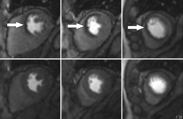 Abnormal ECG results in a 65-year-old man. (a) Short-axis adenosine stress perfusion cardiac MR images (top row) show a severe subendocardial perfusion defect in the LAD territory that becomes more transmural toward the apical segments (arrows). The rest perfusion images (bottom row) are normal. (b) Quantitative perfusion software automatically generates pixel maps that show myocardial perfusion in milliliters per gram per minute at stress (top row) and rest (bottom row) in this patient with an LAD coronary artery occlusion. Note that within the LAD territory, there is no significant change in perfusion (arrows) on the stress images when compared with the rest images, as both are less than about 1 mL/min/g (blue-green color range). This corresponds to the perfusion defect depicted on the raw MRI perfusion images. The normal myocardium reaches the orange color range during stress. (c) Polar maps, also automatically generated from the myocardial perfusion pixel maps, show myocardial blood flow during stress (left) and at rest (middle). The map on the right shows the myocardial perfusion reserve (MPR). All LAD segments have an abnormal MPR (abnormal =MPR <1.5), corresponding to the patient’s LAD coronary artery occlusion.