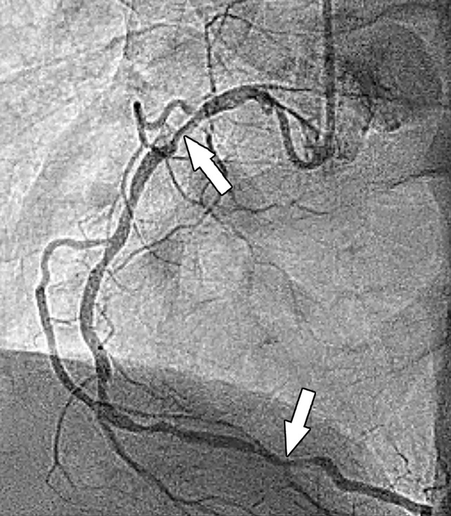 Stress perfusion imaging in a 53-year-old woman with chest pain on exertion and at rest. (a) From left to right in the top row, basal, mid, and apical short-axis cine MR images of the LV show normal global and regional left ventricular systolic function (LV ejection fraction, 61%). In the second row, adenosine stress perfusion images of the same LV locations as in the top row show severe subendocardial perfusion defects involving all myocardial segments. In the third row, the rest perfusion images of the same LV locations are normal. In the fourth row, the LGE images of the same short-axis LV locations show a small focus of enhancement that may represent a microinfarction or an embolic infarction in the mid to apical inferior wall. (b, c) Left anterior oblique (LAO) (b) and LAO caudal (c) invasive coronary angiographic images show severe proximal and distal right coronary artery stenoses on the LAO view (arrows in b), as well as severe stenosis of the distal left main coronary artery on the LAO caudal view (arrow in c).