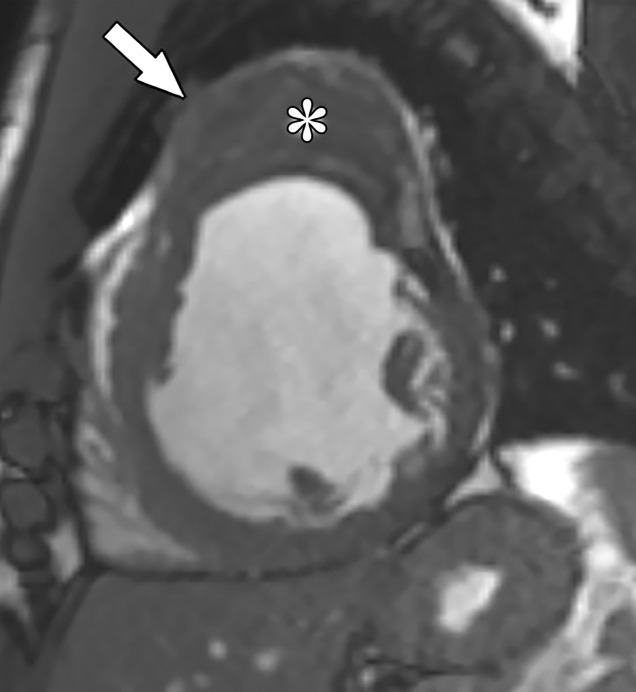 True aneurysm in a 42-year-old man with cardiomyopathy of unknown cause who was referred for further evaluation. (a) Short-axis image from SSFP cine MRI shows a wide-mouthed outpouching (arrow), compatible with an aneurysm, arising from the anterior wall of the LV and containing intermediate-signal-intensity material (*) within it. (b) Short-axis phase-sensitive segmented inversion-recovery LGE image shows diffuse enhancement of the aneurysm wall (arrow), compatible with infarcted myocardium, as well as a low-signal-intensity thrombus within the aneurysm.