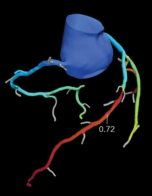 Referral for coronary CT as part of a preoperative evaluation in a 60-year-old man with a history of aortic valve replacement and complete heart block after dual-chamber pacemaker placement. (a) Curved multiplanar reformatted CCTA image of the LAD coronary artery shows a moderate (50%–69%) coronary stenosis (arrow) within the proximal LAD. (b) FFR CT image shows an FFR value of 0.72 distal to the moderate stenosis in the proximal LAD, compatible with a functionally significant coronary stenosis.