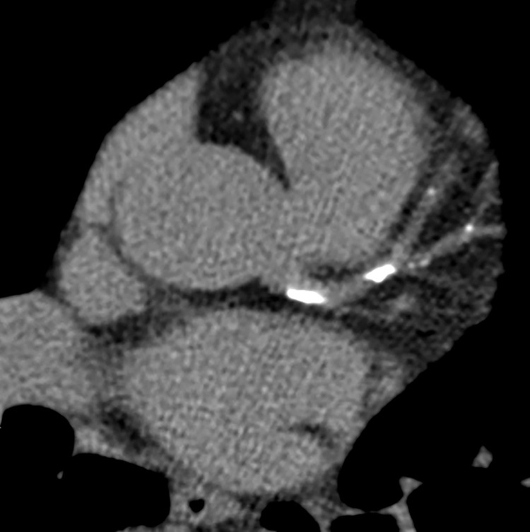 Coronary calcium scoring in a 64-year-old woman with diabetes mellitus and intermittent chest pressure. Selected axial CT image from a coronary calcium score examination shows calcification within the left main coronary artery, left anterior descending (LAD) coronary artery, and diagonal branches. The total quantified coronary calcium was severe, yielding an Agatston score of 622, which represents the 95th percentile for patients of the same age, gender, and race/ethnicity who are free of clinical cardiovascular disease and treated diabetes per the MESA coronary calcium calculator (https://www.mesa-nhlbi.org/Calcium/input.aspx).