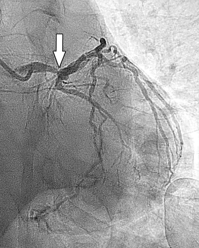 Stress perfusion imaging in a 53-year-old woman with chest pain on exertion and at rest. (a) From left to right in the top row, basal, mid, and apical short-axis cine MR images of the LV show normal global and regional left ventricular systolic function (LV ejection fraction, 61%). In the second row, adenosine stress perfusion images of the same LV locations as in the top row show severe subendocardial perfusion defects involving all myocardial segments. In the third row, the rest perfusion images of the same LV locations are normal. In the fourth row, the LGE images of the same short-axis LV locations show a small focus of enhancement that may represent a microinfarction or an embolic infarction in the mid to apical inferior wall. (b, c) Left anterior oblique (LAO) (b) and LAO caudal (c) invasive coronary angiographic images show severe proximal and distal right coronary artery stenoses on the LAO view (arrows in b), as well as severe stenosis of the distal left main coronary artery on the LAO caudal view (arrow in c).