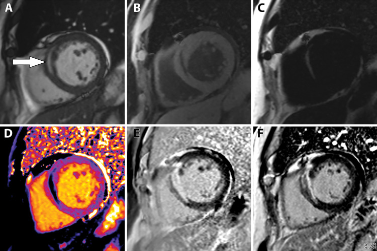 Fatty metaplasia of chronic MI in a 67-year-old man with a history of MI many years prior. Cardiac MR images show midwall fatty metaplasia within a chronic near-transmural MI of the basal septum. Short-axis image from cine SSFP MRI, A, shows midwall hyperintensity within the basal anteroseptum (arrow). Water separation, B, and fat separation, C, images confirm that the midwall abnormality is fat. T1 map, D, shows a midwall area in the basal anteroseptum that has a T1 value consistent with that of fat. Early, E, and late, F, gadolinium enhancement images show a near-transmural MI involving the basal anteroseptal wall.