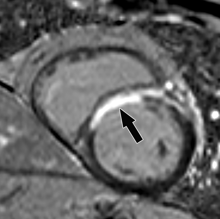 Subendocardial enhancement in a 44-year-old man with a history of CAD, MI, and tobacco use who was referred for cardiac MRI to assess MI size. Short-axis LGE cardiac MR image of the LV shows subendocardial-based enhancement, with about 75% transmural extent within the basal septal wall (arrow), as well as some extension into the adjacent anterior wall. The transmural extent of enhancement is greater than 50%, which indicates a lower likelihood of recovery with revascularization.