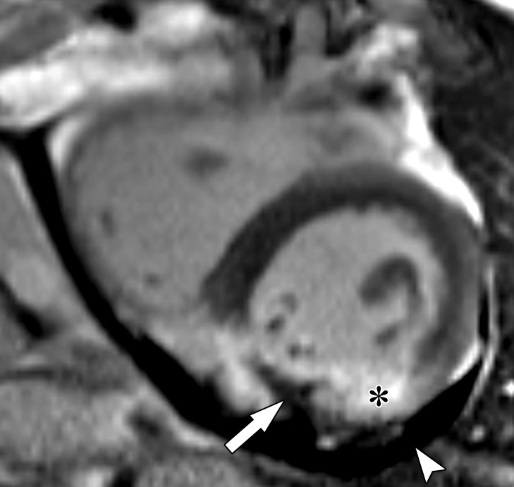 Intramyocardial hematoma in a 60-year-old man with a history of MI. Recent echocardiographic findings (not shown) were suggestive of expanding posterior wall intramyocardial hemorrhage and dissecting intramyocardial hematoma after an acute MI. (a) Short-axis phase-sensitive inversion-recovery LGE image shows a transmural MI (*), with an area of nonenhancing intramyocardial hematoma (arrow). Pericardial effusion is also depicted (arrowhead). (b) Coronal CT image shows contrast material infiltration into the myocardial wall (arrow). Moderate pericardial effusion (*) is present. LA = left atrium, RA = right atrium.