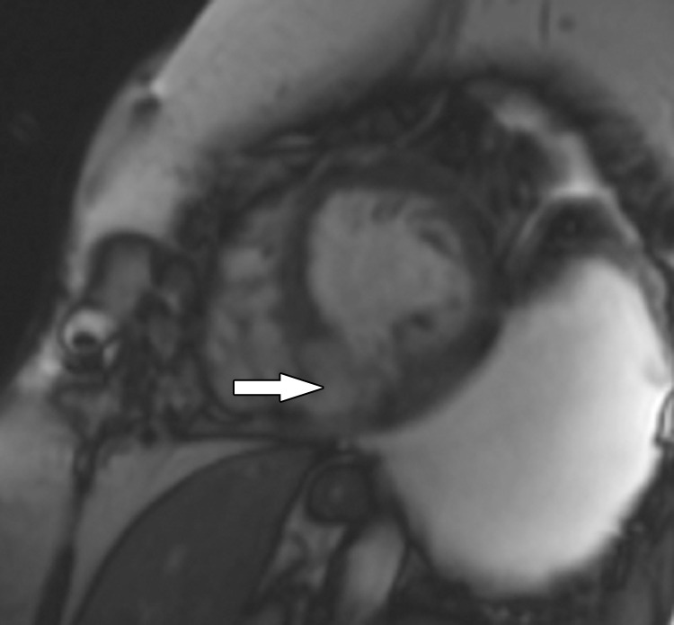 Inferior MI in a 61-year-old woman who developed shortness of breath. Echocardiogram (not shown) depicted an ischemic ventricular septal defect in the location of a prior MI, and the patient was referred for cardiac MRI for further evaluation. Short-axis image from SSFP cine MRI shows an ischemic ventricular septal defect (arrow) between the left and right ventricles at the site of the MI. Supplemental MRI cine clips of the short axis and left ventricular outflow show a flow jet from the LV into the right ventricle through the ischemic ventricular septal defect (Movies 1, 2).