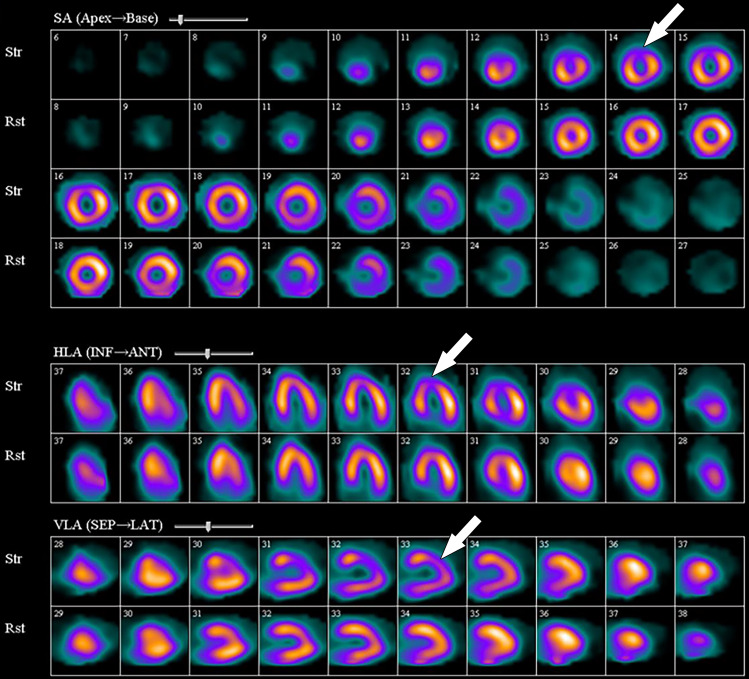 99mTc–sestamibi images show a perfusion defect (arrows) at stress in the mid LAD coronary territory distribution along with transient ischemic dilatation, consistent with myocardial ischemia and possible multivessel disease.