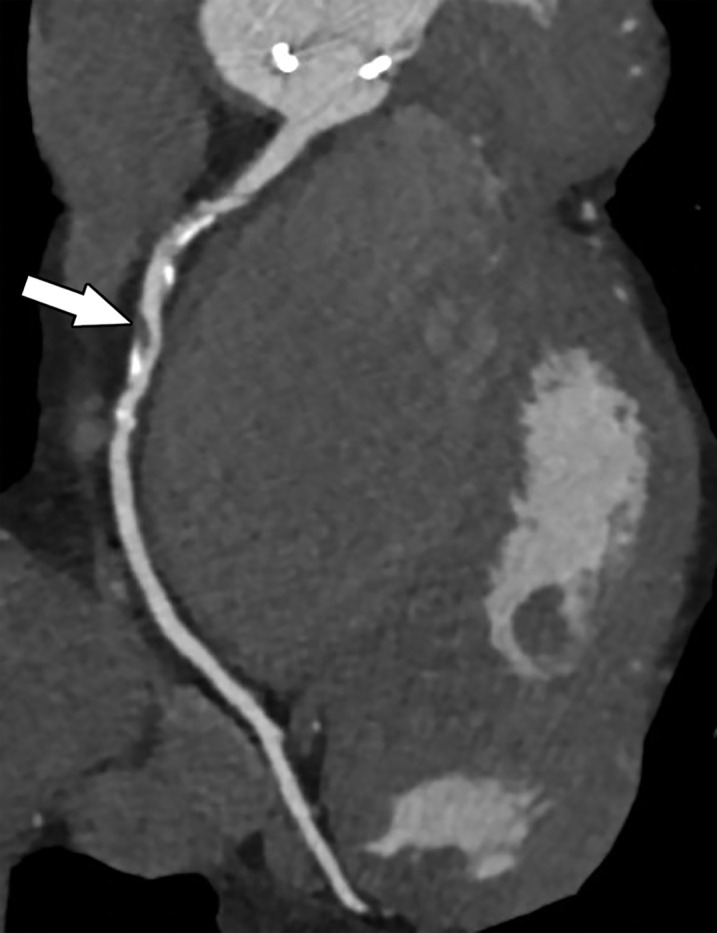 Exertional dyspnea in a 69-year-old man. (a) Curved multiplanar reformatted CCTA image of the right coronary artery (RCA) shows scattered calcified and noncalcified plaque within the proximal and mid vessel. There is an area of moderate (50%–69%) stenosis (arrow), secondary to mixed calcified and noncalcified plaque within the mid RCA. (b) FFR CT image shows an FFR value of 0.86 distal to the moderate RCA stenosis, consistent with no functional significance of the mid RCA stenosis.