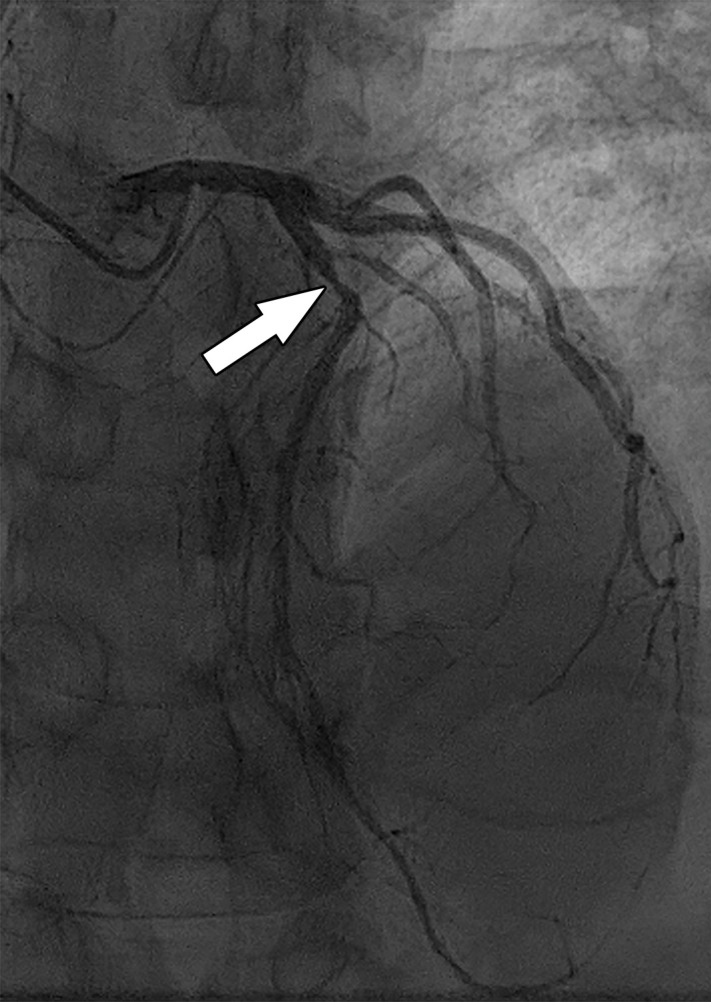 Abnormal exercise stress ECG result in a 52-year-old woman with type II diabetes mellitus. (a) Curved multiplanar reformatted CCTA image of the LAD coronary artery shows a severe (≥70%) mid LAD stenosis (arrow). (b) FFR CT image shows an FFR value less than 0.5 within the LAD distal to the mid LAD stenosis, compatible with a functionally significant coronary artery stenosis. (c) Coronary angiographic image during coronary catheterization before percutaneous coronary intervention again shows the mid LAD stenosis (arrow).