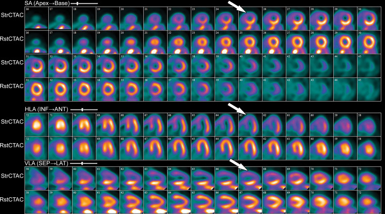 82Rb PET perfusion images show a severe perfusion defect (arrows) in the distribution of the LAD coronary artery at stress (StrCTAC) and normal perfusion at rest (RstCTAC), compatible with ischemic myocardium. Metabolic images are not shown. ANT = anterior, HLA = horizontal long axis, INF = inferior, SA = short axis, SEP = septal, VLA = vertical long axis. Keys are the same for Figures 13, 18, and 19.