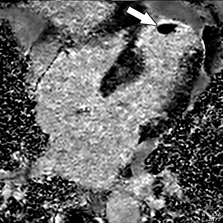 Left ventricular apical aneurysm with an apical thrombus in a 69-year-old woman with a history of MI. Four-chamber phase-sensitive inversion-recovery LGE image shows a left ventricular thrombus (arrow) in an aneurysmal infarcted left ventricular apex. Note the transmural enhancement of the left ventricular apex, compatible with MI.