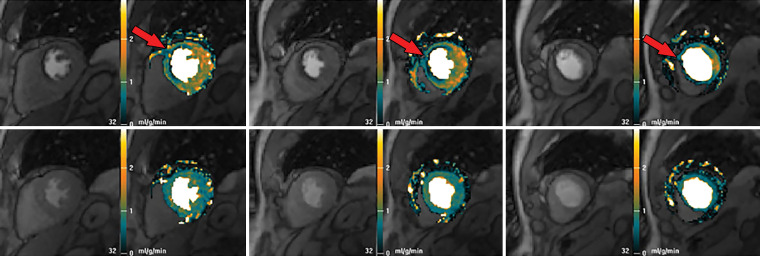 Abnormal ECG results in a 65-year-old man. (a) Short-axis adenosine stress perfusion cardiac MR images (top row) show a severe subendocardial perfusion defect in the LAD territory that becomes more transmural toward the apical segments (arrows). The rest perfusion images (bottom row) are normal. (b) Quantitative perfusion software automatically generates pixel maps that show myocardial perfusion in milliliters per gram per minute at stress (top row) and rest (bottom row) in this patient with an LAD coronary artery occlusion. Note that within the LAD territory, there is no significant change in perfusion (arrows) on the stress images when compared with the rest images, as both are less than about 1 mL/min/g (blue-green color range). This corresponds to the perfusion defect depicted on the raw MRI perfusion images. The normal myocardium reaches the orange color range during stress. (c) Polar maps, also automatically generated from the myocardial perfusion pixel maps, show myocardial blood flow during stress (left) and at rest (middle). The map on the right shows the myocardial perfusion reserve (MPR). All LAD segments have an abnormal MPR (abnormal =MPR <1.5), corresponding to the patient’s LAD coronary artery occlusion.