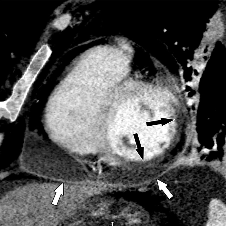 Postmyocardial infarction pericarditis (Dressler syndrome) in a 58-year-old woman who returned to the emergency department for chest pain 12 days after discharge following an acute MI. Short-axis 4-mm-thick minimum intensity projection (MinIP) image shows transmural hypoattenuation of the anterolateral, inferolateral, and inferior segments at the midcavity level, owing to recent proximal left circumflex coronary artery territory infarction (black arrows). A moderate-size pericardial effusion is depicted, with areas of pericardial enhancement (white arrows), consistent with pericarditis. The patient’s symptoms dramatically improved after initiation of anti-inflammatory medications.