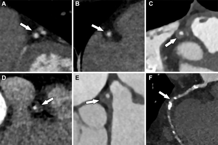 Multiplanar reformatted images of the coronary arteries from CCTA show various degrees of stenosis (arrows): A, approximately 10% stenosis of the left anterior descending coronary artery, consistent with minimal coronary stenosis; B, approximately 25% stenosis of the right coronary artery, consistent with mild coronary stenosis; C, approximately 55% stenosis, as well as positive remodeling of the right coronary artery, consistent with moderate stenosis; D, approximately 75% stenosis of the right coronary artery, consistent with severe stenosis; E, approximately 65% stenosis and positive remodeling of the left main coronary artery, consistent with severe stenosis; and, F, completely occluded mid right coronary artery that is supplied distally by collateral vessels.