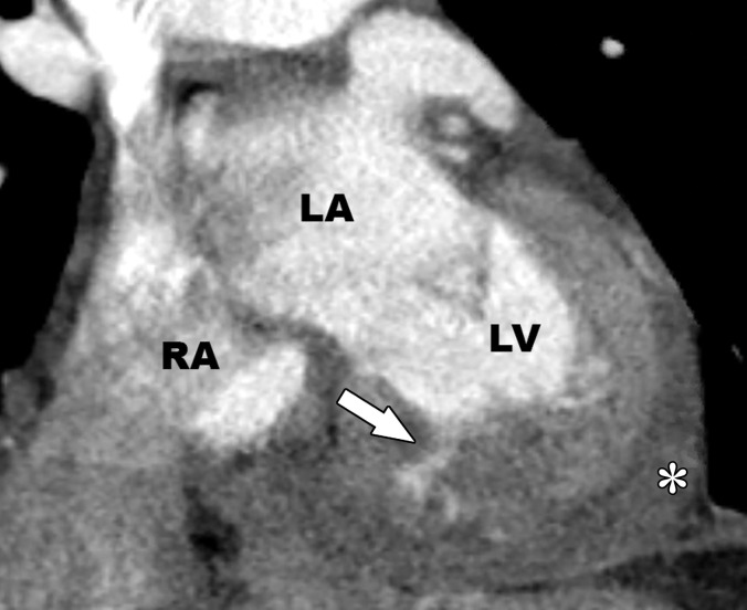 Intramyocardial hematoma in a 60-year-old man with a history of MI. Recent echocardiographic findings (not shown) were suggestive of expanding posterior wall intramyocardial hemorrhage and dissecting intramyocardial hematoma after an acute MI. (a) Short-axis phase-sensitive inversion-recovery LGE image shows a transmural MI (*), with an area of nonenhancing intramyocardial hematoma (arrow). Pericardial effusion is also depicted (arrowhead). (b) Coronal CT image shows contrast material infiltration into the myocardial wall (arrow). Moderate pericardial effusion (*) is present. LA = left atrium, RA = right atrium.