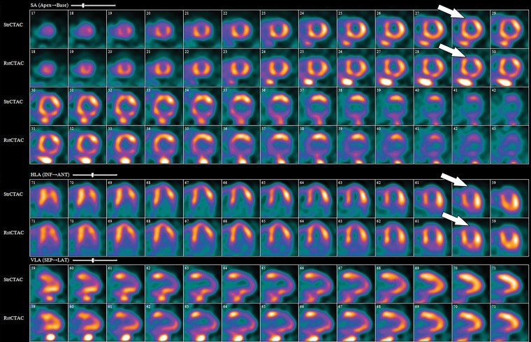 82Rb PET perfusion images show a fixed perfusion defect on both stress (StrCTAC) and rest (RstCTAC) images (arrows) within the anterior wall. This matched pattern is compatible with MI. Metabolic images are not shown.