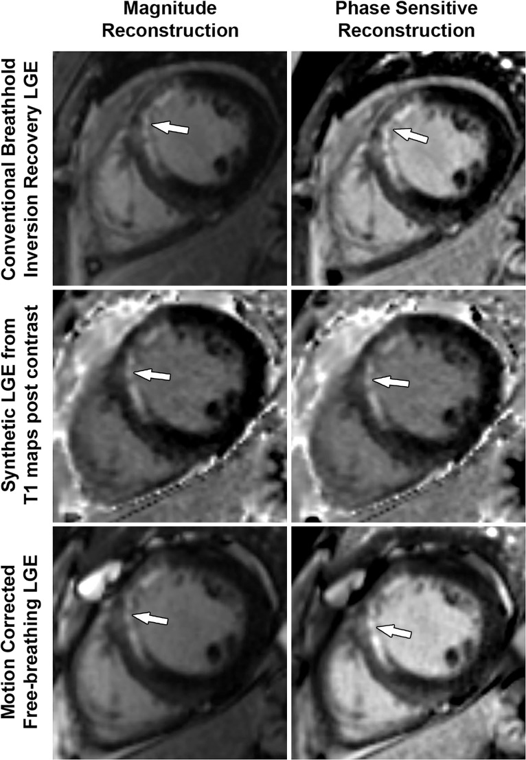 Comparison of LGE images of an MI in the LAD territory in a 48-year-old man with an LAD occlusion, obtained by three different acquisition methods and two different image reconstruction methods, shows the similarity of diagnostic information. Left column: conventional magnitude image reconstruction. Right column: phase-sensitive inversion-recovery reconstruction. Top row: conventional breath-hold segmented inversion recovery. Middle row: synthetic inversion-recovery LGE images generated from postcontrast T1 maps. Knowing the T1 value on a pixel-by-pixel basis allows estimation of image intensity on a typical inversion-recovery LGE image at any inversion time, including the optimal inversion time for nulling normal myocardium. Bottom row: motion-corrected free-breathing LGE method. The image quality of the synthetic and motion-corrected methods is good, and they have the advantage that they can be performed without breath hold. However, they have lower resolution than the conventional breath-hold segmented inversion-recovery LGE images.