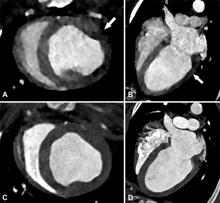 Perfusion defect in a 54-year-old man with chest pain. Short-axis, A, and four-chamber, B, CT images from a dynamic CT stress perfusion examination show a large transmural perfusion defect within the lateral wall (arrows), corresponding to a hemodynamically significant left circumflex lesion. Short-axis, C, and four-chamber, D, rest perfusion CT images are normal.