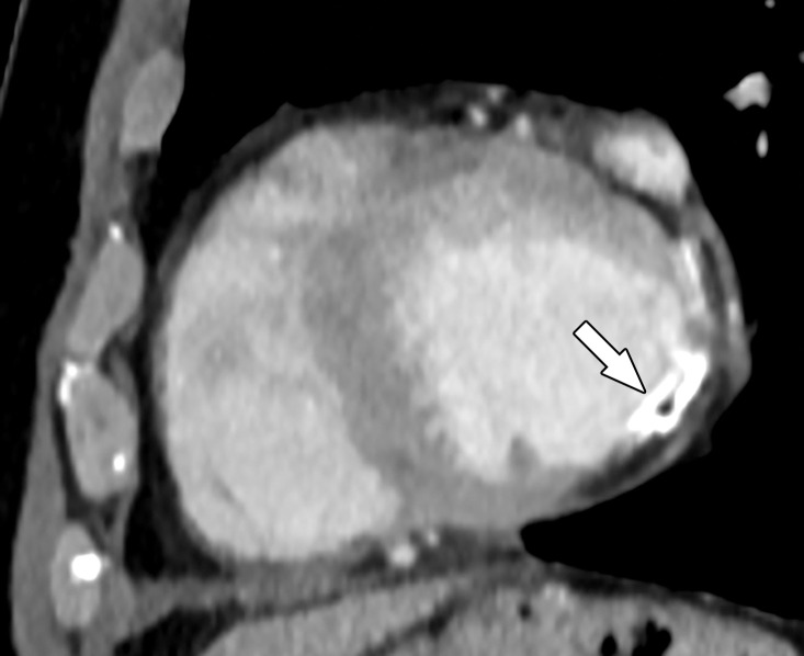 Four-chamber (a) and short-axis (b) CT images in a 65-year-old man show an area of hypoenhancement and calcification within a thinned nonenhancing basal inferolateral wall (arrow), compatible with a chronic MI. This MI was incidentally detected on a routine nongated contrast-enhanced chest CT image obtained for chronic dyspnea.