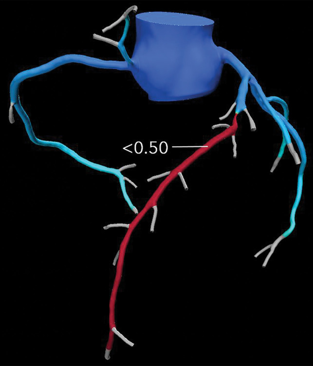 Abnormal exercise stress ECG result in a 52-year-old woman with type II diabetes mellitus. (a) Curved multiplanar reformatted CCTA image of the LAD coronary artery shows a severe (≥70%) mid LAD stenosis (arrow). (b) FFR CT image shows an FFR value less than 0.5 within the LAD distal to the mid LAD stenosis, compatible with a functionally significant coronary artery stenosis. (c) Coronary angiographic image during coronary catheterization before percutaneous coronary intervention again shows the mid LAD stenosis (arrow).