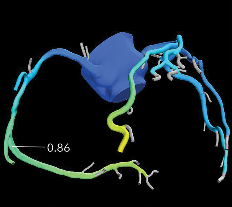 Exertional dyspnea in a 69-year-old man. (a) Curved multiplanar reformatted CCTA image of the right coronary artery (RCA) shows scattered calcified and noncalcified plaque within the proximal and mid vessel. There is an area of moderate (50%–69%) stenosis (arrow), secondary to mixed calcified and noncalcified plaque within the mid RCA. (b) FFR CT image shows an FFR value of 0.86 distal to the moderate RCA stenosis, consistent with no functional significance of the mid RCA stenosis.