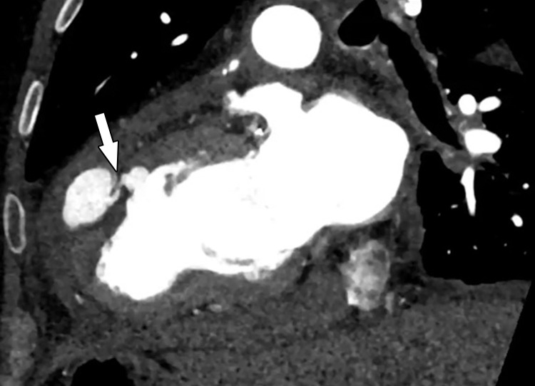 Pseudoaneurysm in a 61-year-old man with worsening chest pain 2 weeks after coronary artery bypass surgery who was referred for CT angiography for further evaluation. CT angiographic image shows an outpouching of contrast material with a narrow neck (arrow) arising from the LV, compatible with a pseudoaneurysm.