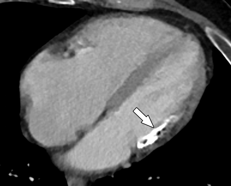 Four-chamber (a) and short-axis (b) CT images in a 65-year-old man show an area of hypoenhancement and calcification within a thinned nonenhancing basal inferolateral wall (arrow), compatible with a chronic MI. This MI was incidentally detected on a routine nongated contrast-enhanced chest CT image obtained for chronic dyspnea.