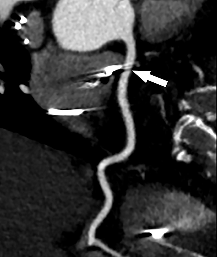 Curved multiplanar reformatted image from CCTA shows beam-hardening artifact (arrow) within the right coronary artery, secondary to a pacemaker lead within the right atrium.