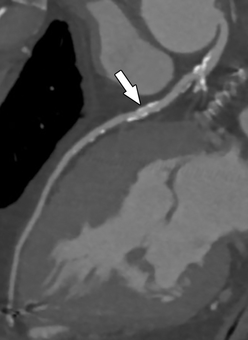 Referral for coronary CT as part of a preoperative evaluation in a 60-year-old man with a history of aortic valve replacement and complete heart block after dual-chamber pacemaker placement. (a) Curved multiplanar reformatted CCTA image of the LAD coronary artery shows a moderate (50%–69%) coronary stenosis (arrow) within the proximal LAD. (b) FFR CT image shows an FFR value of 0.72 distal to the moderate stenosis in the proximal LAD, compatible with a functionally significant coronary stenosis.