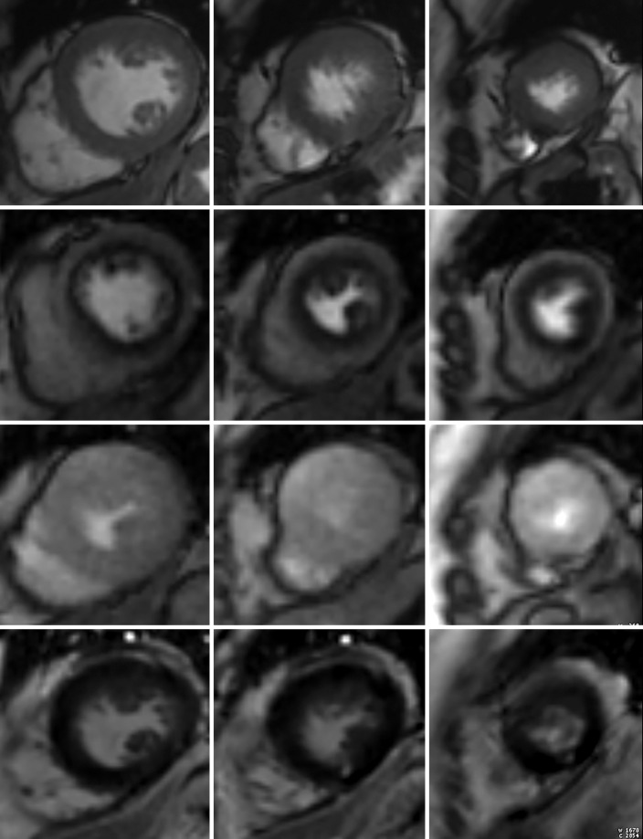 Stress perfusion imaging in a 53-year-old woman with chest pain on exertion and at rest. (a) From left to right in the top row, basal, mid, and apical short-axis cine MR images of the LV show normal global and regional left ventricular systolic function (LV ejection fraction, 61%). In the second row, adenosine stress perfusion images of the same LV locations as in the top row show severe subendocardial perfusion defects involving all myocardial segments. In the third row, the rest perfusion images of the same LV locations are normal. In the fourth row, the LGE images of the same short-axis LV locations show a small focus of enhancement that may represent a microinfarction or an embolic infarction in the mid to apical inferior wall. (b, c) Left anterior oblique (LAO) (b) and LAO caudal (c) invasive coronary angiographic images show severe proximal and distal right coronary artery stenoses on the LAO view (arrows in b), as well as severe stenosis of the distal left main coronary artery on the LAO caudal view (arrow in c).