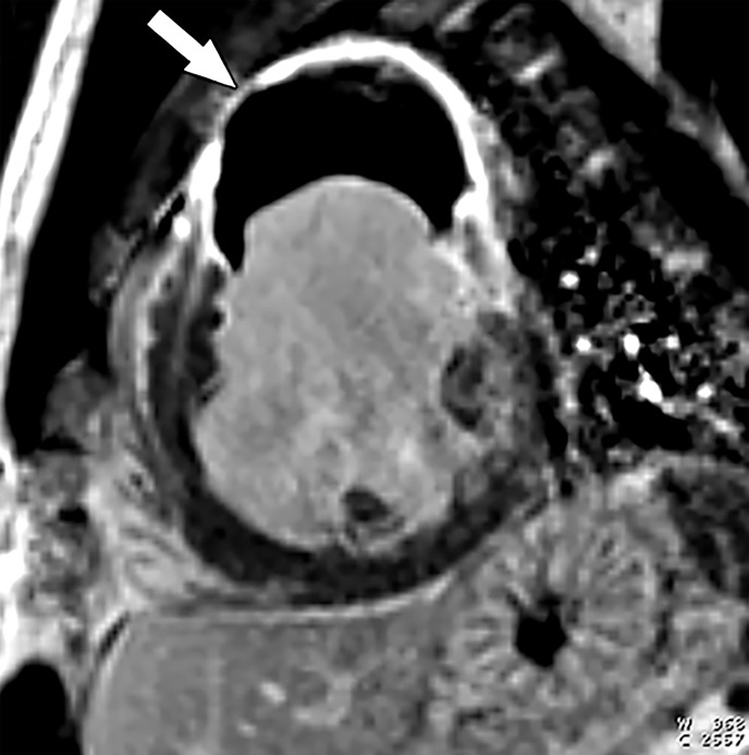 True aneurysm in a 42-year-old man with cardiomyopathy of unknown cause who was referred for further evaluation. (a) Short-axis image from SSFP cine MRI shows a wide-mouthed outpouching (arrow), compatible with an aneurysm, arising from the anterior wall of the LV and containing intermediate-signal-intensity material (*) within it. (b) Short-axis phase-sensitive segmented inversion-recovery LGE image shows diffuse enhancement of the aneurysm wall (arrow), compatible with infarcted myocardium, as well as a low-signal-intensity thrombus within the aneurysm.