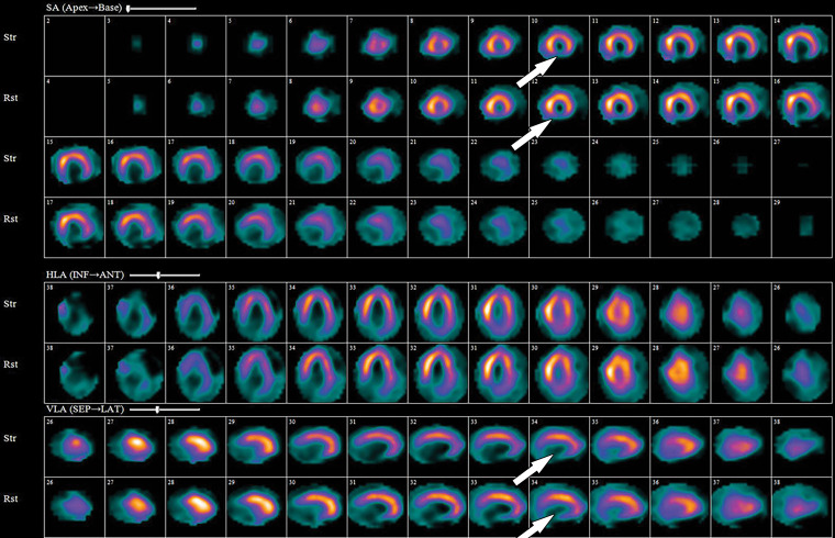 99mTc-sestamibi images show a fixed defect in the inferior wall (arrows), which is highly suggestive of a right coronary artery territory MI. Rst = rest, Str = stress.