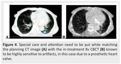 
Figure 4. Special care and attention need to be put while matching
the planning CT image (A) with the in-treatment Kv CBCT (B) known
to be highly sensitive to artifacts, in this case due to a prosthetic heart
valve.
