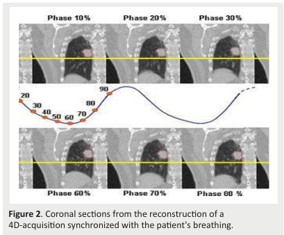 
Figure 2. Coronal sections from the reconstruction of a
4D-acquisition synchronized with the patient's breathing.
