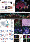 Figure 1. Multimodal profiling of cutaneous melanoma. A, Conceptual framework of sample processing for cyclic immunofluorescence (CyCIF), high-resolution CyCIF, and microregion transcriptomics: GeoMx and PickSeq (mrSEQ). Abbreviations for annotated histologies are shown below with color-coding used in subsequent figure panels. B, A 30-plex CyCIF image of a section of specimen MEL1-1 showing selected markers for epidermis (pan-CK: cyan) and tumor cells (SOX10: red), highlighting annotated histologies and microregions (mROIs) that were subjected to mrSEQ (white +s). This specimen was likely torn during slide processing and, thus, spatial arrangements in the region marked with a blue dashed boundary are not considered reliable. Other mrSEQ sites are shown in Supplementary Fig. S2A. C, CyCIF image of MEL1-1 corresponding to the MIS and adjacent regions of inflammatory and terminal regression (IR) and TR, respectively; outlined by dashed white lines). Rectangles depict the positions of 110 × 110 μm ROIs in which high-resolution 3D deconvolution microscopy was performed. The region highlighted with orange is magnified in G. D, Uniform manifold approximation and projection (UMAP) of single-cell data derived from CyCIF of patient MEL1 labeled by cell type (top) and the signal intensities of individual markers (bottom). Markers used for cell-type calls are shown in Supplementary Fig. S1C. The UMAP plot was built using 50,000 single cells that were randomly sampled from the full data set (n = 1.1 × 106). E, Cell-type assignments (with data points representing the centroids of cells) mapped to their physical locations in a portion of the bTIL region lying just beyond the IM in MEL1-1. F, H&E image of the same region as in E. Regions of tumor and stroma are separated by dashed black lines. G, A 21-plex high-resolution CyCIF image of a MEL1-1 MIS region (orange square in C) with selected markers shown as a maximum-intensity projection staining for DNA (blue), tumor (SOX10: white), and T cells (CD4: green, CD8: red). The dermal–epidermal junction is denoted with a white dashed line and all FOXP3+ cells (as determined from other image channels; see Supplementary Fig. S1F) are denoted with an asterisk. Scale bar, 25 μm. Note that all images in G– J derive from a single multiplex CyCIF 3D image stack. H, Magnified regions from G (outlined with a yellow box) showing staining of DNA (blue) and CD4 (green), CD8 (red), and TIM3 (white). Four cell types are labeled including a Treg (green box – shown in J) and two CD8+ CTLs interacting with a tumor cell (shown in I). The dashed line follows the axis of immune synapse polarization and gives rise to the intensity plot in I. The orange box depicts the locations of representative images in I. Scale bar, 10 μm. I, Single optical section images of the immune synapse in H showing staining of tumor (SOX10: white), DNA (blue), and cell membrane (HLA-A: magenta) along with a series of single-channel images of functional T-cell markers. Right, quantified spatial distribution of CD8 and CD3 along the dashed line in H. J, Inset from H (outlined with a green square). Single optical section images of a tumor cell interacting with a Treg. Top: staining for tumor (SOX10: white), cell membrane (HLA-A: magenta), and DNA (blue); bottom: staining for Treg (ICOS: cyan). The two z-sections shown are spaced 2.2 μm apart.