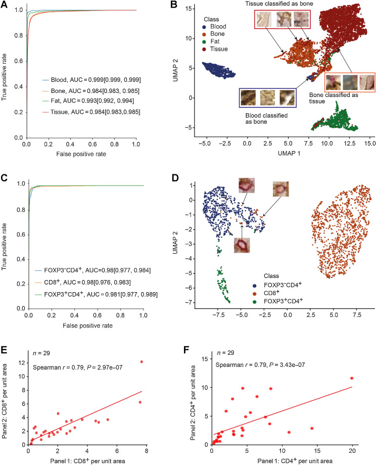 Figure 3. Performance evaluation of MoSaicNet and AwareNet deep learning models: A, The ROC curves and AUC values of the MoSaicNet superpixel classifier. The values in brackets indicate the 95% CI. B, Two-dimensional mapping of superpixels using MoSaicNet learned 200-dimensional features after dimensionality reduction by UMAP. C, The ROC curves and AUC values of single-cell classifier model on separately held test data. The values in brackets indicate the 95% CI. D, UMAP features visualization of deep learned features by AwareNet single-cell classifier CNN. E and F, Validation of AwareNet model using correlation of density of CD8+ (E) and CD4+ (F) cells in panel 1 and panel 2.