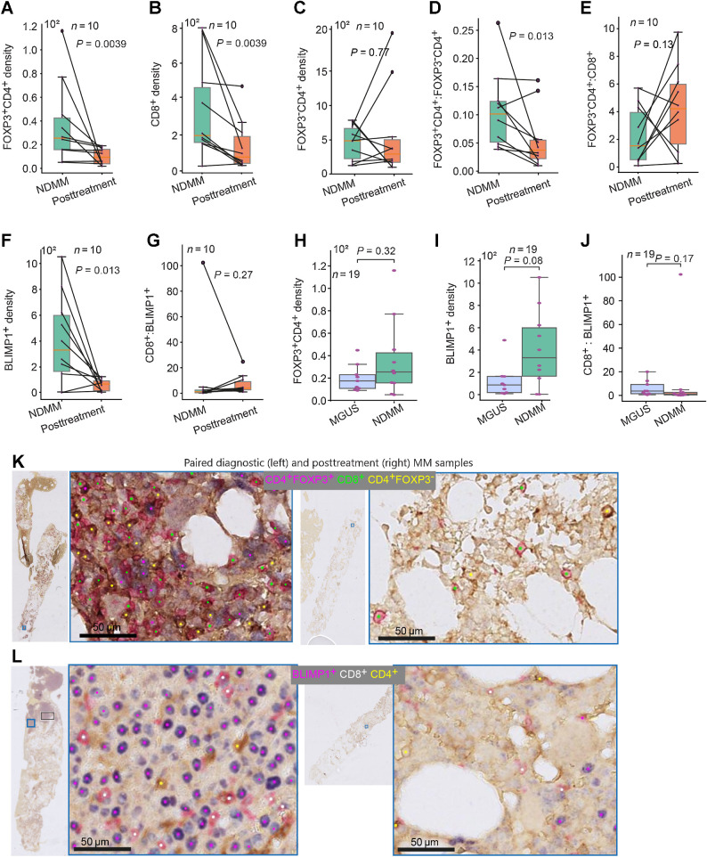 Figure 5. Density of immune T cells and plasma cells in MGUS, NDMM, and posttreatment samples. A–G, Box plots showing the difference in density of FOXP3+CD4+ (A), the density of CD8+ (B), the density of FOXP3−CD4+ (C), FOXP3+CD4+:FOXP3−CD4+ ratio (D), FOXP3+CD4+:CD8+ ratio (E), density of BLIMP1+ (F), and CD8+:BLIMP1+ ratio (G) between paired NDMM samples and posttreatment samples (n = 10 pairs). H–J, Box plot showing the difference in density of FOXP3+CD4+(H), the density of BLIMP1+ cells (I), and CD8+:BLIMP1+ cells (J) between MGUS and NDMM samples (n = 19). K and L, Sample images showing the reduction of the density of FOXP3+CD4+ and CD8+ cells (K) and BLIMP1+ cells (L) at posttreatment compared with paired NDMM samples. The cell density is presented per 1 mm2 tissue area.