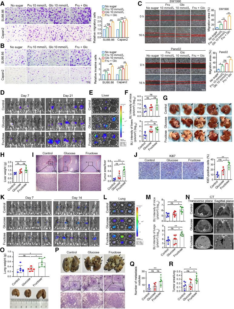 Figure 4. Fructose promotes invasion and metastasis of PDAC cells. A and B, The migratory (A) and invasive (B) abilities of SU86.86 and Capan2 cells were determined by Transwell assay in the four media used in the above experiments. C, Wound-healing analysis of the migration ability of SW1990 and Panc02 cells under the four indicated conditions. D, Bioluminescence imaging of three groups of mice on day 21 in the tumor metastasis model with splenic injection of Panc02/luciferase cells. E, Imaging of the excised livers of the above three groups of mice. F, Statistical analysis of BLI intensity of mice (D) and the excised livers (E). G, Representative images of the excised livers of each group. Black arrows, tumor metastasis nodules on the liver surface. H, The weight of the excised livers in each group of mice. I, Representative images of H&E staining of the liver (×40 and ×200) and the proportion of tumor area in the whole liver of the three groups. J, Representative images of Ki67 staining in liver metastases (×400) and corresponding statistical results. K, In vivo imaging of mice in three groups on days 7 and 14 after tail vein injection of Panc02/luciferase cells. The imaging system can only detect a maximum of 5 mice at a time, so the sixth mouse in each group was detected alone. L, Imaging of isolated lungs of the above three groups. M, BLI intensity of mice in Fig. 3K and lungs in Fig. 3L. N, Representative micro-CT images of the lungs from each group. O, Weight of isolated lungs from each group. P, Representative images of isolated lungs from each group (black arrows, tumor metastatic nodules on the lung surface) and H&E-staining images of lung tissue sections (×40 and ×200). M, the tumor metastasis. Q, The metastatic nodules in the lungs of different groups. R, Proportion of tumor area in the total lungs of three groups. All data are shown as mean ± SD. Analysis was performed using one-way ANOVA followed by a Tukey test; ns, nonsignificant; *, P < 0.05; **, P < 0.01; n = 3 in cell experiments, n = 5 in liver metastasis model, and n = 6 in lung metastasis model.