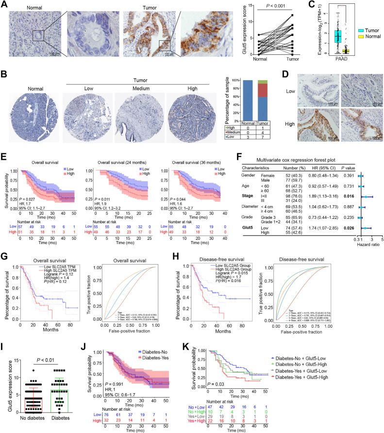 Figure 1. Glut5 was highly expressed in PDAC tissues and associated with worse prognosis. A, The expression level and location of Glut5 protein in PDAC tissues (IHC, ×400) and their corresponding normal tissues were identified by IHC staining (n = 50). B, Expression levels of Glut5 protein in PDAC and normal pancreatic tissues in the Human Protein Atlas database. C, Expression levels of Glut5 mRNA in PDAC and normal pancreatic tissues in the TCGA database. D, Representative images of low and high Glut5 expressions in PDAC tissues by IHC staining (IHC, ×400; n = 129). E, Relationship between Glut5 expression levels and the prognosis of patients with PDAC. F, Multivariate Cox regression analysis was used to evaluate independent risk factors for prognosis of patients with PDAC. CI, confidence interval; HR, hazard ratio. G and H, Relationships between Glut5 mRNA expression levels and overall survival (G) and disease-free survival (H) of patients with PDAC in the TCGA database. I, Glut5 protein expression levels in PDAC tissues from diabetic and non-diabetic patients. J, The effect of diabetes on the survival of patients with PDAC. K, The effect of diabetes combined with Glut5 expression levels in tumor tissues on the prognosis of patients with PDAC. All data are expressed as mean ± SD. Analysis was performed using a paired samples t test (A) or an unpaired Student t test (B and I) or the Kaplan–Meier method (E, J, and K).