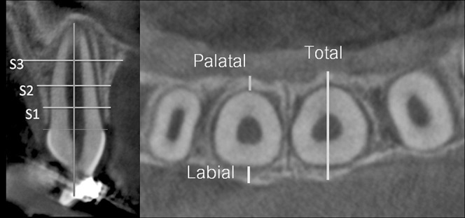 Figure 4. Location of alveolar bone thickness measurements.