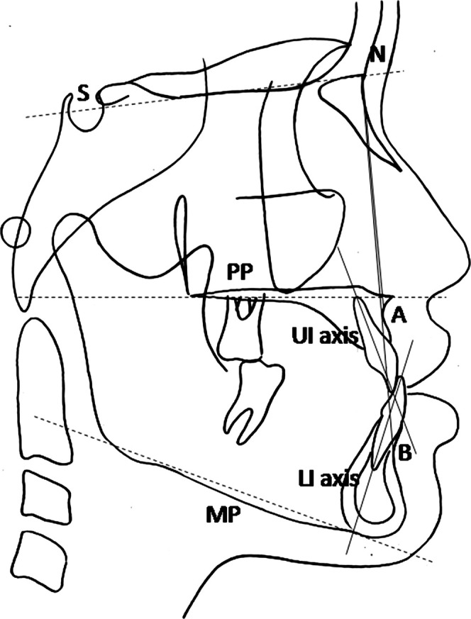 Figure 3. Cephalometric reference points and lines used in this study.