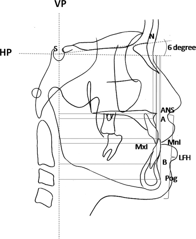 Figure 2. Cephalometric reference planes and points used in this study.