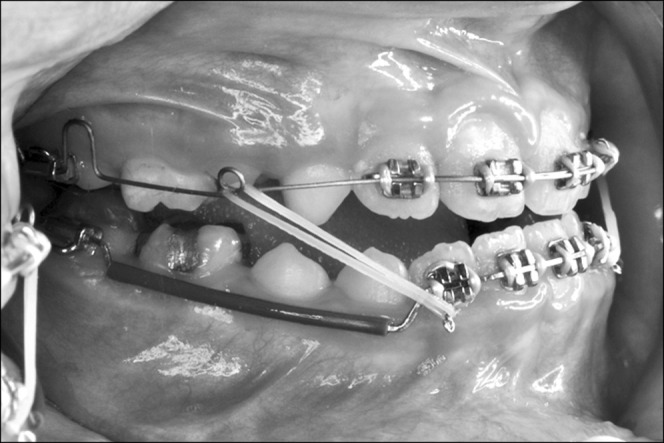 Figure 1. Clinical setup with light force generated by the maxillary archwire with advancing loops and Class III elastics.