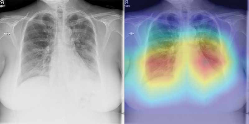 Examples of chest radiographs and the network-generated heatmaps from the reader study test set. (a) A 64-year-old man with coronavirus disease 2019 (COVID-19) pneumonia who was classified correctly by CV19-Net but incorrectly classified by all three radiologists (left). The heatmap generated by CV19-Net overlaid on the original image (right). The red highlights the anatomic regions that contributed most to the CV19-Net prediction. (b) A 58-year-old woman with non–COVID-19 pneumonia who was classified correctly by CV19-Net but incorrectly classified by all three radiologists. The heatmap highlighted the anatomic regions that contribute most to the CV19-Net prediction (right).