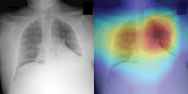 Examples of chest radiographs and the network-generated heatmaps from the reader study test set. (a) A 64-year-old man with coronavirus disease 2019 (COVID-19) pneumonia who was classified correctly by CV19-Net but incorrectly classified by all three radiologists (left). The heatmap generated by CV19-Net overlaid on the original image (right). The red highlights the anatomic regions that contributed most to the CV19-Net prediction. (b) A 58-year-old woman with non–COVID-19 pneumonia who was classified correctly by CV19-Net but incorrectly classified by all three radiologists. The heatmap highlighted the anatomic regions that contribute most to the CV19-Net prediction (right).