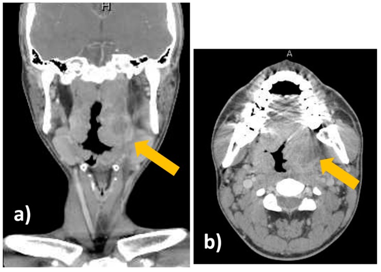 Ultrasound-Guided Needle Aspiration of Peritonsillar Abscesses: Utility ...