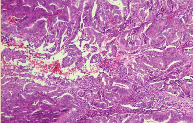 Histopathological Pattern Of Endometrial Biopsies In Patients With 