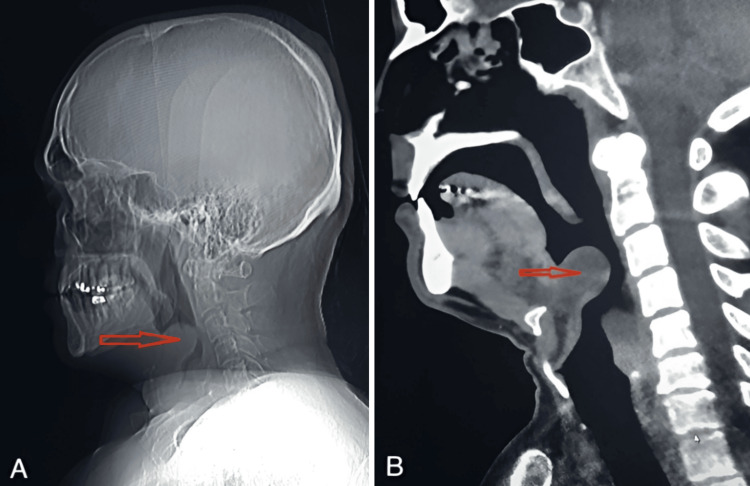 Managing Epiglottitis in Adults: A Comprehensive Case Study - PMC